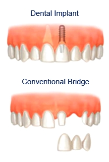 dental, implants, Sheffield, cosmetic, dentistry, dental, flint
